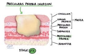 Karcinóm pažeráka
